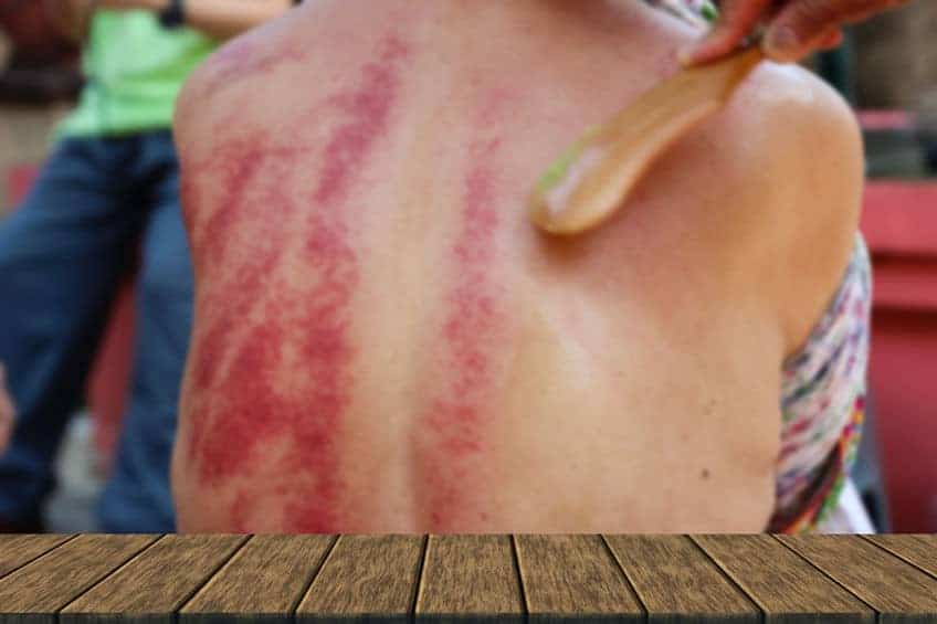 SIde Effects of Gua Sha
