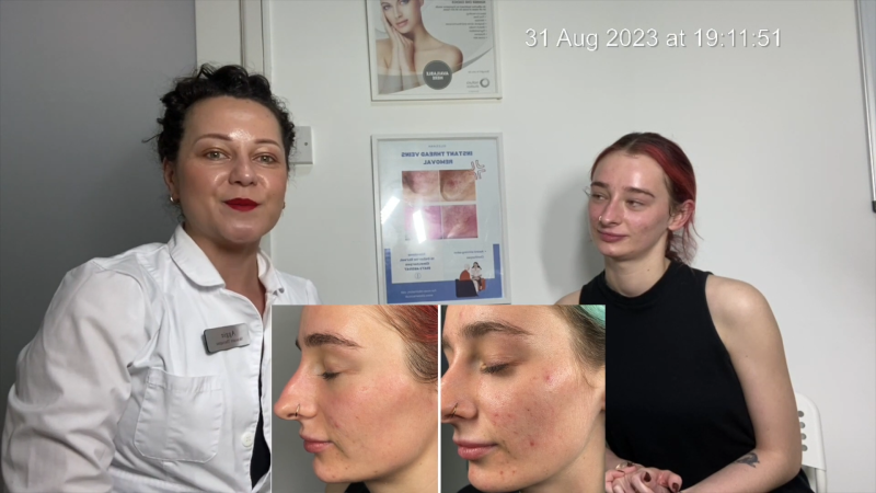 Aggie-Singh-treating-Acne-in-TSG2023-Video-8-0-16-screenshot