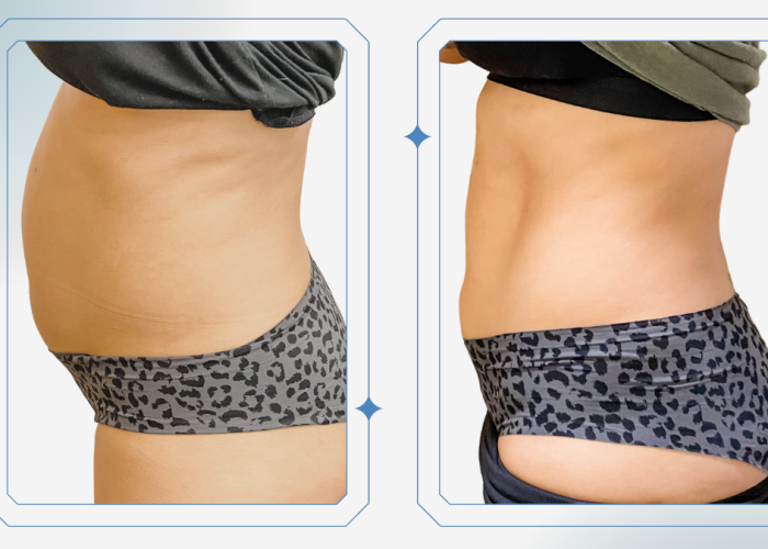 Fat Freezing