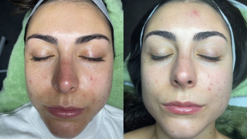 Treating-Acne-in-Just-8-Weeks-Michael-Razzanos-Journey-in-The-Skin-Games